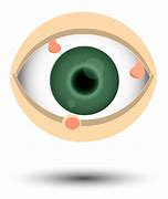 Image result for Malignant Eyelid Lesions