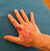 Image result for Grosjean's Burnt Hands