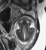 Image result for Anencephaly Radiology
