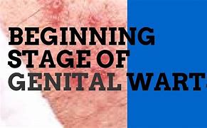 Image result for Early Genital Warts