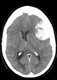 Image result for Clinoidal Meningioma