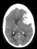 Image result for Skull Base Meningioma
