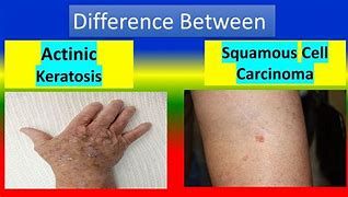 Image result for Keratosis vs Skin Cancer