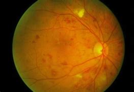 Image result for Cotton-Wool Spots Retina