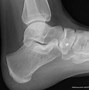 Image result for Accessory Navicular Bone Foot