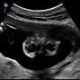 Image result for Infant Anencephaly