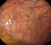 Image result for Sessile Polyp in Sigmoid Colon