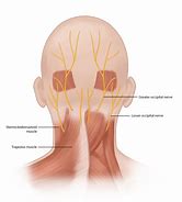 Image result for Nerve Headache