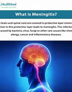 Image result for Meningitis Bacterial Disease