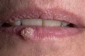 Image result for Molluscum Warts On Lip