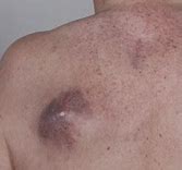 Image result for Melanoma On Chest