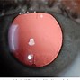 Image result for Toric Lenses Cataract Surgery