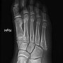 Image result for Oblique Fracture 5th Metatarsal