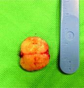 Image result for 2 Centimeter Tumor