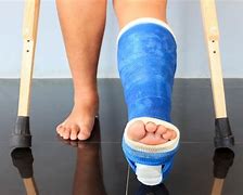 Image result for Fractured Leg Cast