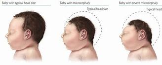 Image result for Anencephaly vs Microcephaly