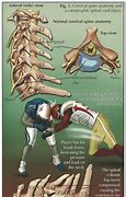Image result for Football Player Spine Board