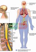 Image result for C5 Paralysis