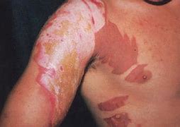Image result for 2nd Degree Partial Thickness Burn