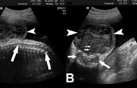 Image result for Acrania Prenatal