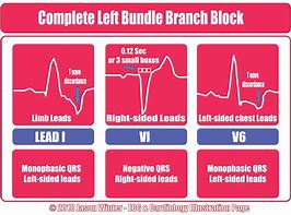 Image result for Bundle Branch Block ECG