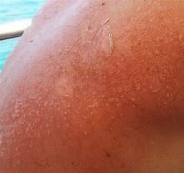Image result for Girl Purple Sun Burn Shoulders