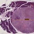 Image result for Tumor Pictures and Sizes