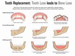 Image result for Jaw Bone After Tooth Extraction