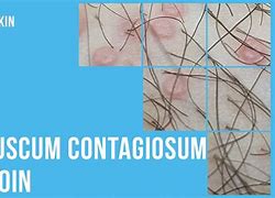 Image result for Molluscum Contagiosum Groin Area