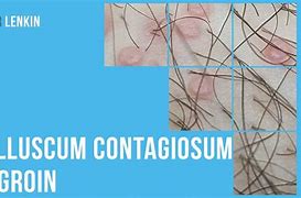 Image result for Molluscum Contagiosum Groin