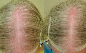 Image result for Female Hair Loss Before and After