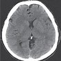 Image result for Dermoid Cyst Brain