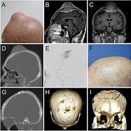 Image result for Sarcoma Bone Cancer Skull