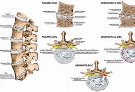 Image result for intervertevral