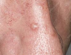 Image result for Basal Cell Carcinoma On Nose Symptoms