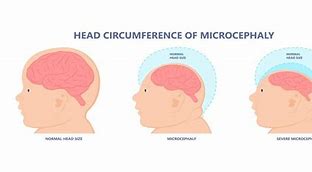 Image result for Microcephaly Hat