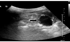 Image result for Ultrasound Cyst Adjacent to Ovary