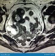 Image result for Hematosalpinx