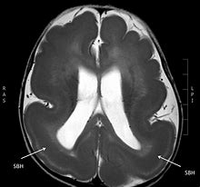 Image result for Lissencephaly MRI Normal