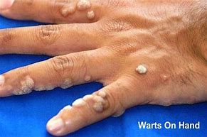 Image result for Seed Warts On Hands