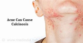 Image result for calcicosis