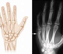 Image result for fractured pinkie fingers heal time