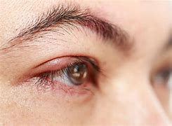 Image result for Pimple On Lower Eyelid