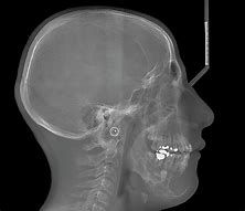 Image result for Lower Jaw Bone Cancer