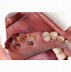 Image result for Rotten Tooth Extraction