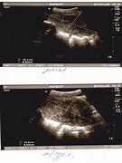 Image result for 5 Cm Uterine Fibroid