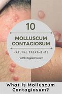 Image result for Molluscum Contagiosum Herbal Treatment