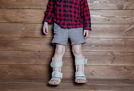 Image result for Boys with Rickets