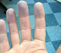 Image result for cyanosis
