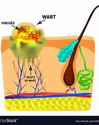 Image result for Wart Root